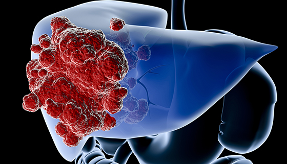 Liver Tumor Treatment in Electronic City